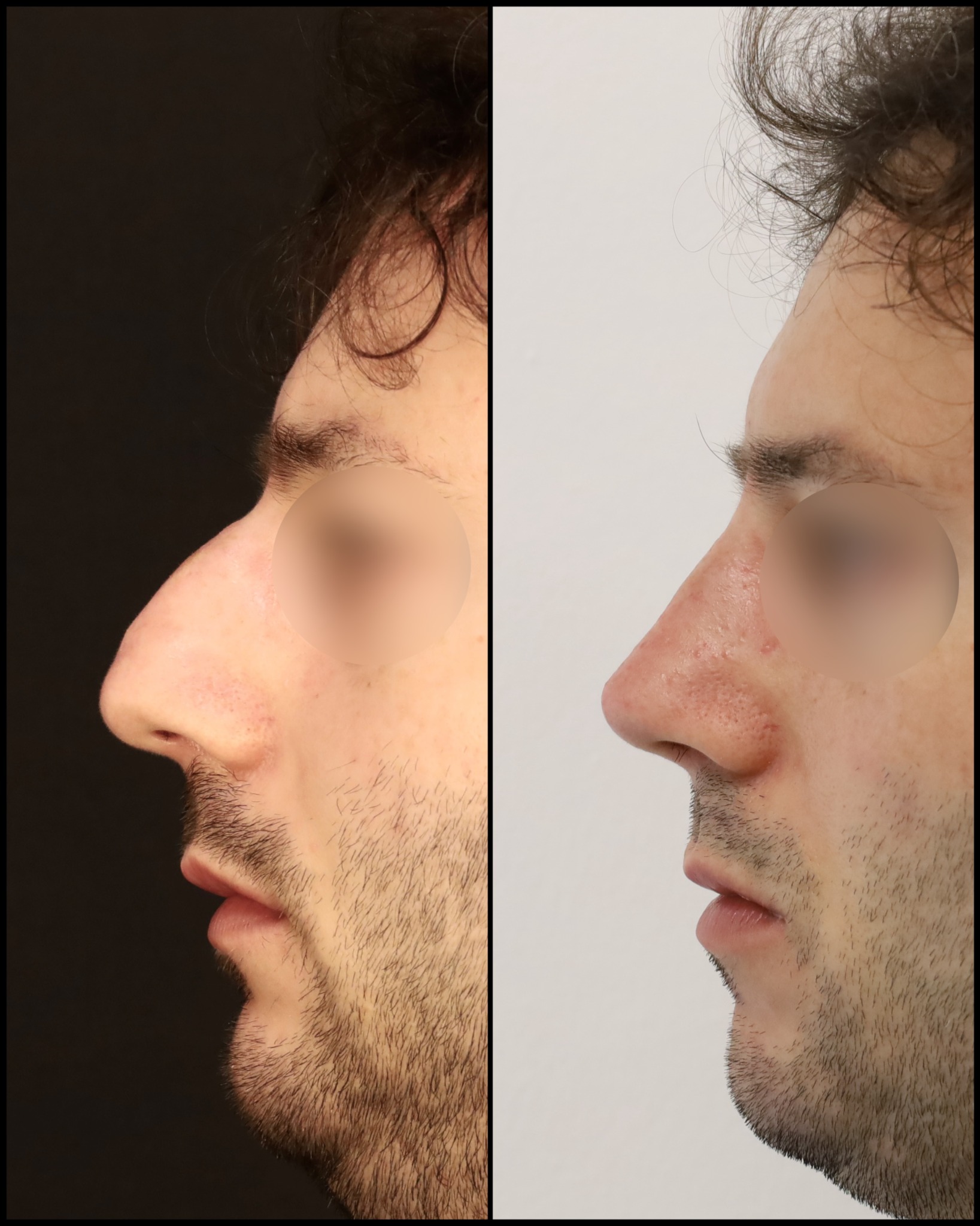 Confronto fotografico fornito dal chirurgo, profilo