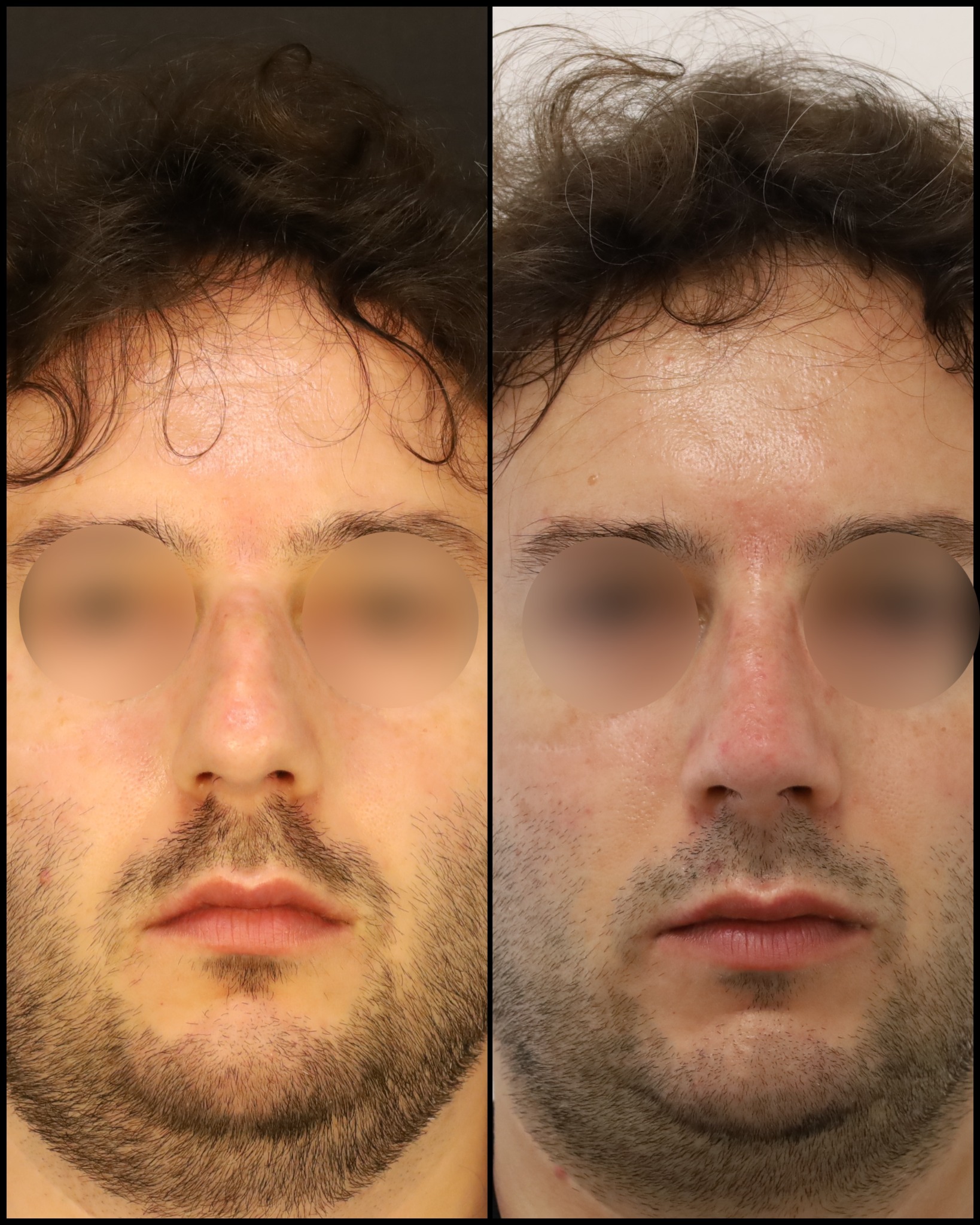Confronto fotografico fornito dal chirurgo, frontale